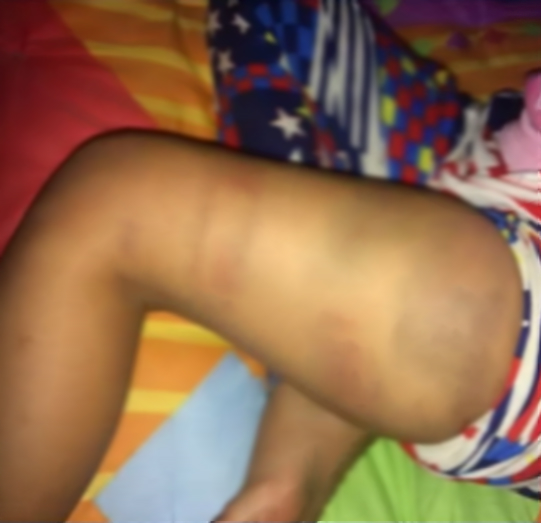 Padrastro golpeó a niña de 6 años con un palo por haber cogido $1.000