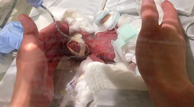 El bebé más pequeño del mundo sobrevivió y fue enviado a su casa
