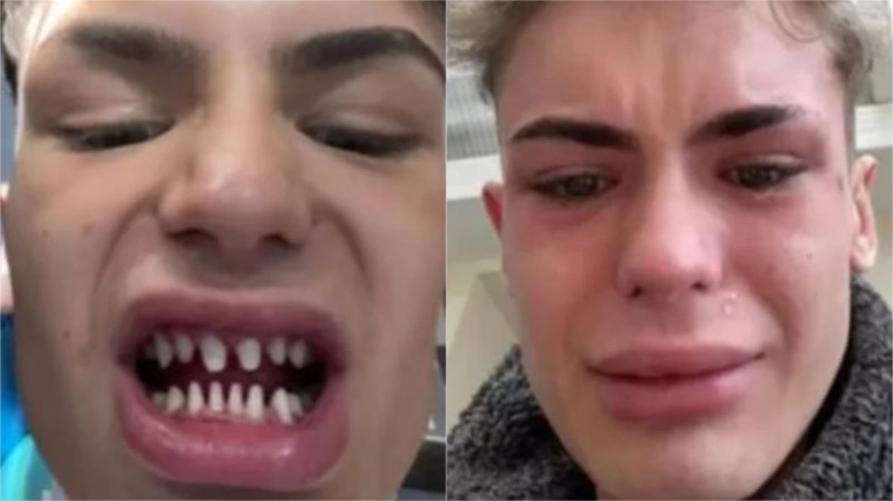 ¿Dientes de tiburón? Así quedó un joven después de un diseño de sonrisa