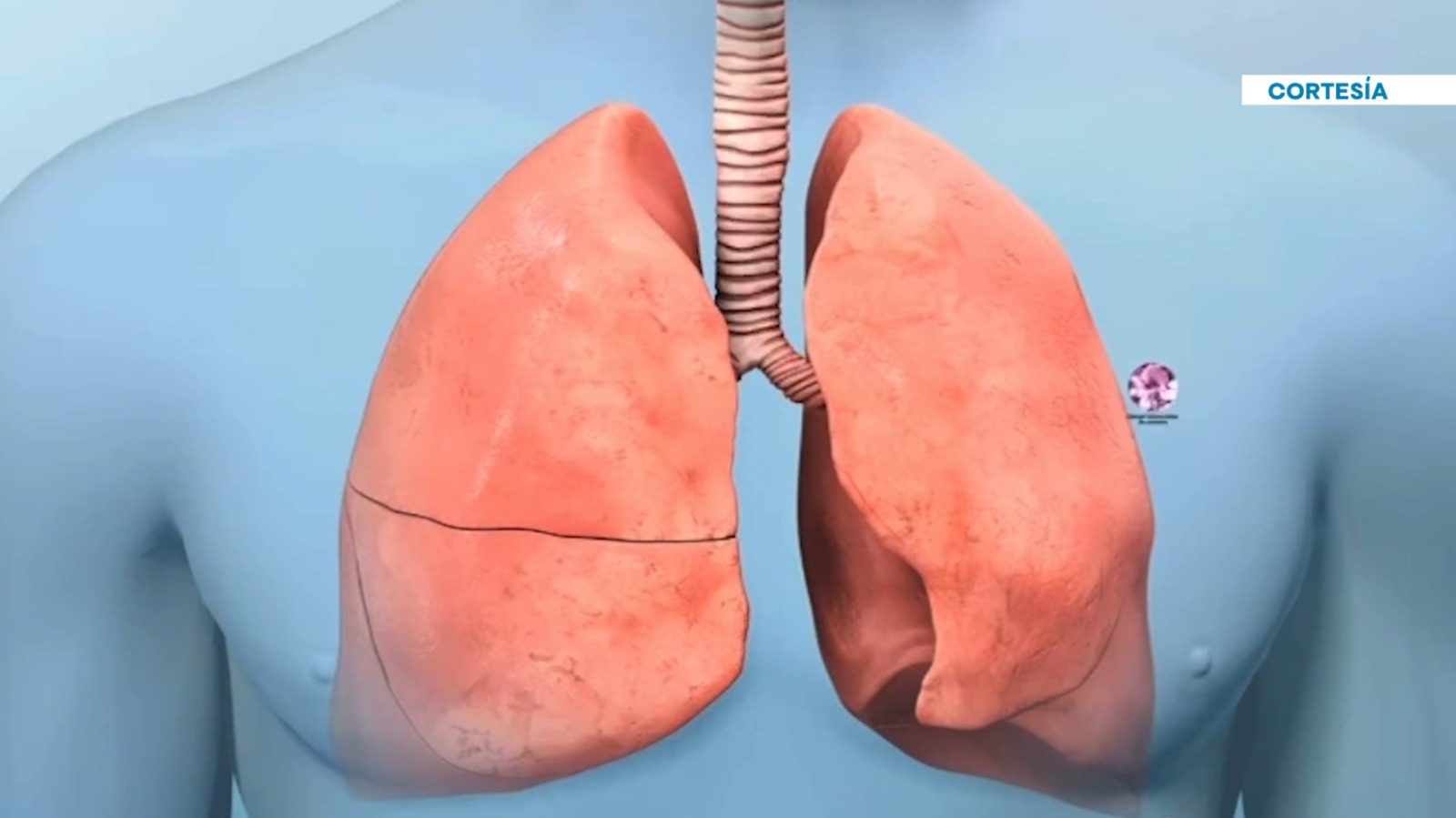 Cáncer de pulmón: una de las mayores causas de mortalidad en el mundo