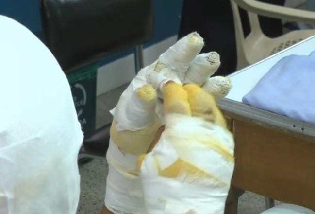 Antioquia superó el centenar de quemados con pólvora en diciembre