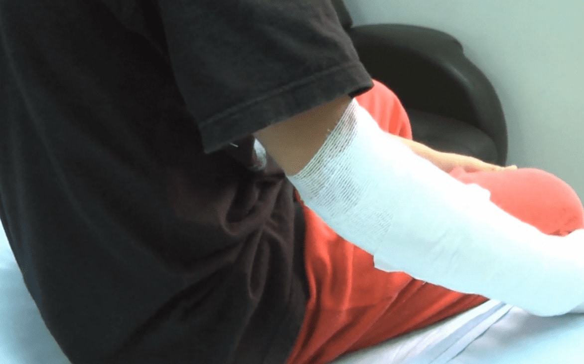 Con cinco nuevos casos, Antioquia eleva a 72 la cifra de quemados con pólvora este año