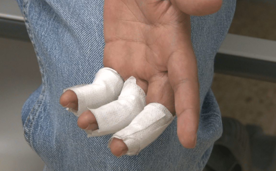 Antioquia ya registra 20 quemados con pólvora en el inicio de la temporada decembrina