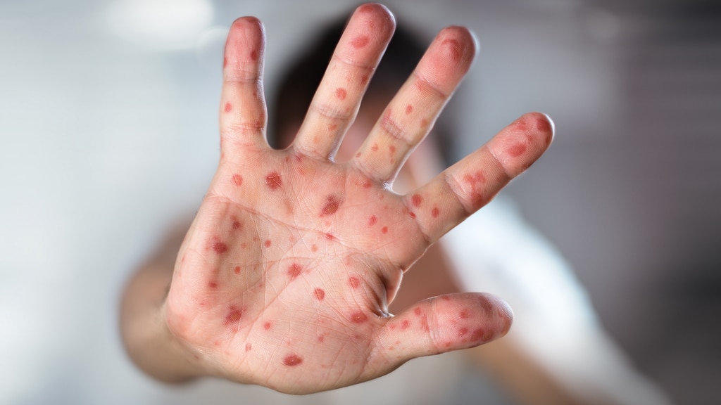 Autoridades de salud analizan 4 casos de viajeros internacionales con sarampión