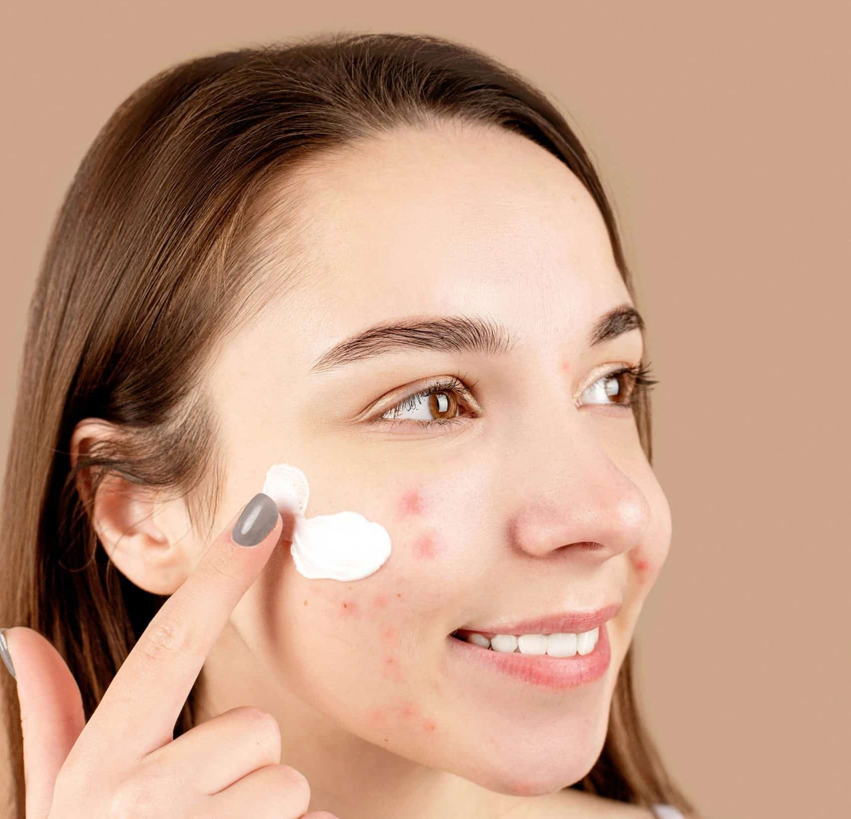 ¿Manchas en la piel? Descubra cómo identificarlas y prevenirlas